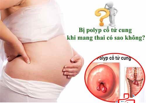 Mẹ bị polyp tử cung có ảnh hưởng đến thai không?