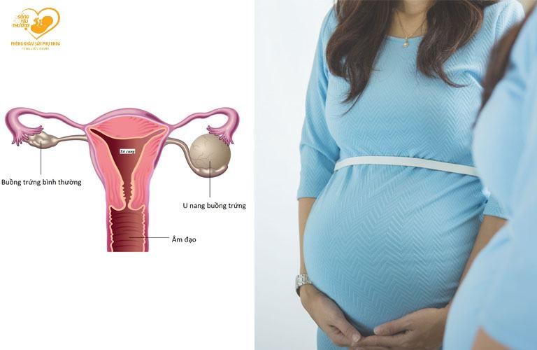 U nang buồng trứng ảnh hưởng ảnh hưởng đến thai kỳ như thế nào?