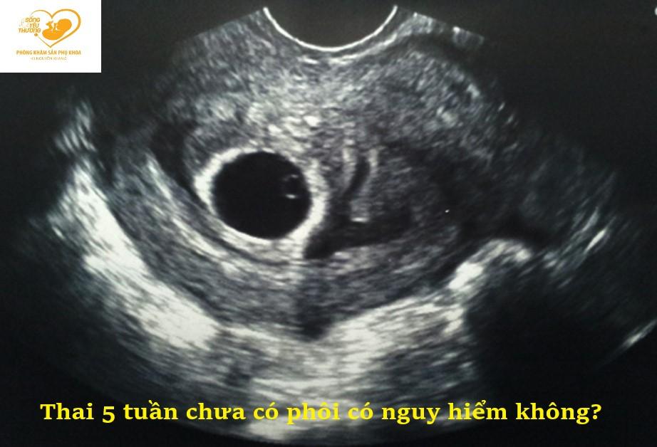 Thai 5 tuần chưa có phôi thai có nguy hiểm không?