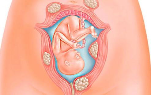 Dấu hiệu nào báo hiệu bạn có thể mắc u xơ tử cung khi mang thai
