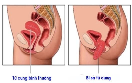 Phòng ngừa bệnh sa sinh dục - Phòng khám sản phụ khoa 43 Nguyễn Khang