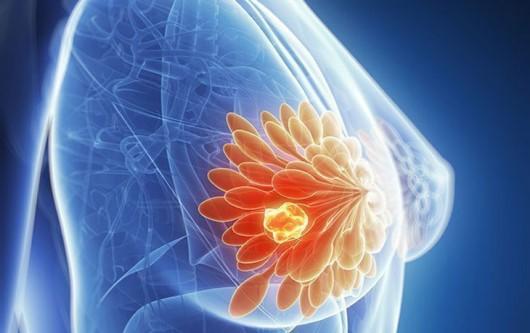 Ung thư tuyến vú và những điều bạn cần biết
