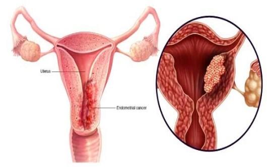 Ung thư thân tử cung nguyên nhân, triệu chứng và chẩn đoán điều trị