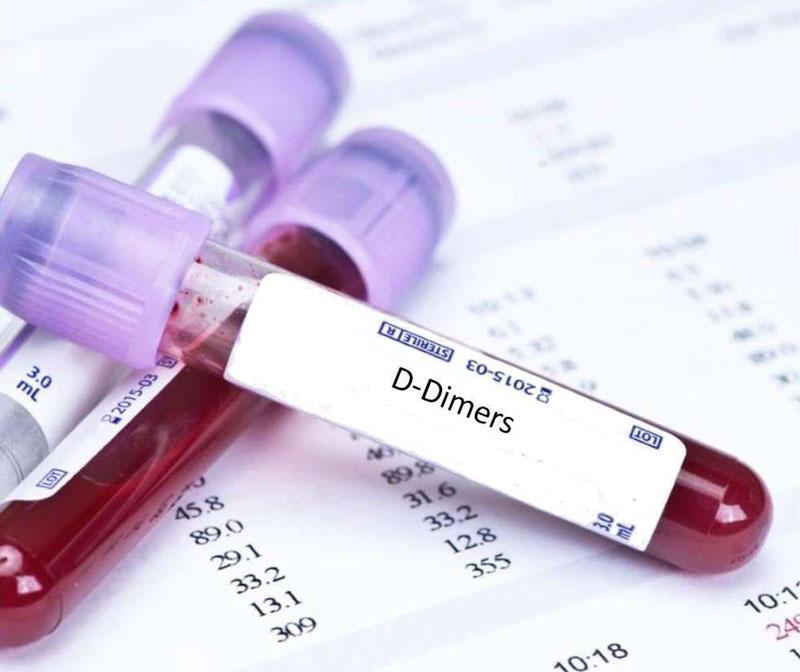 Xét nghiệm D-Dimer là gì, ý nghĩa xét nghiệm D-Dimer.