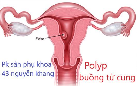 Polyp buồng tử cung có mang thai được không?