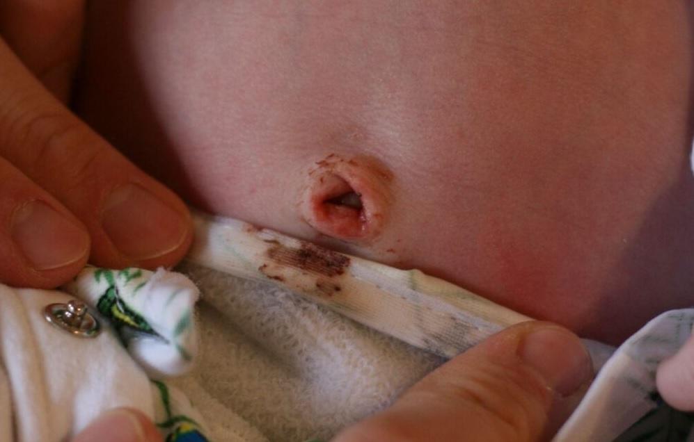 Một số triệu chứng nhiễm trùng rốn ở trẻ sơ sinh