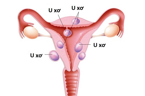 Phụ nữ khi mang thai có u xơ tử cung cần làm gì?