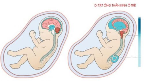 Xét nghiệm phát hiện dị tật ống thần kinh ở thai nhi