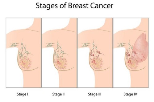 Các giai đoạn ung thư vú