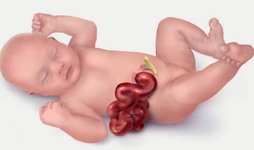 Hở thành bụng bẩm sinh có phát hiện được trên siêu âm thai không ?