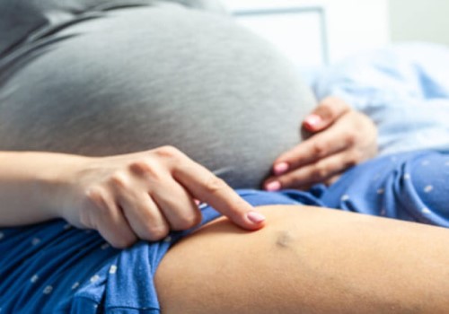 Suy giãn tĩnh mạch khi mang thai và cách phòng ngừa