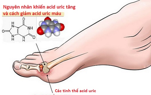 Nguyên nhân khiến acid uric tăng và cách giảm acid uric máu