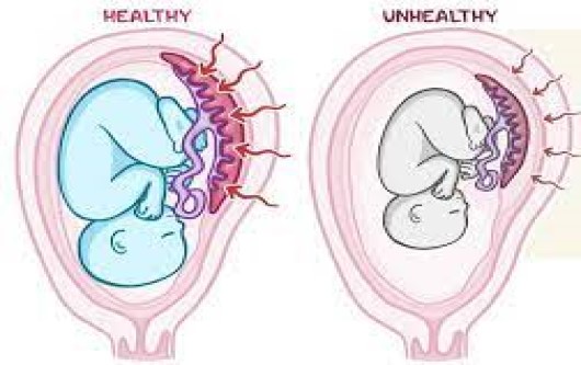 Thai chậm phát triển trong tử cung