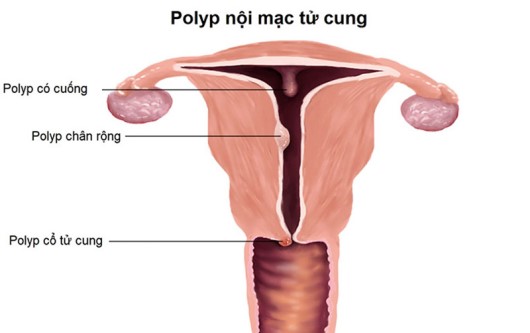 polyp buồng tử cung