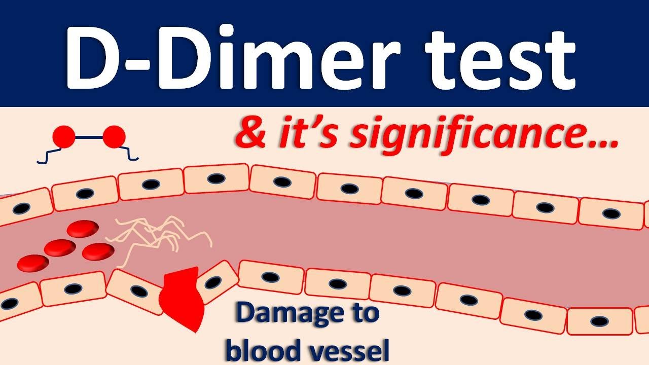 ý nghĩa xét nghiệm d-dimer