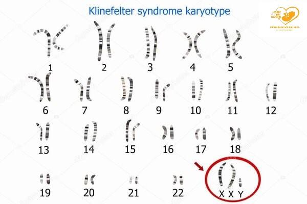 Sàng lọc hội chứng Klinefelter trong thai kỳ
