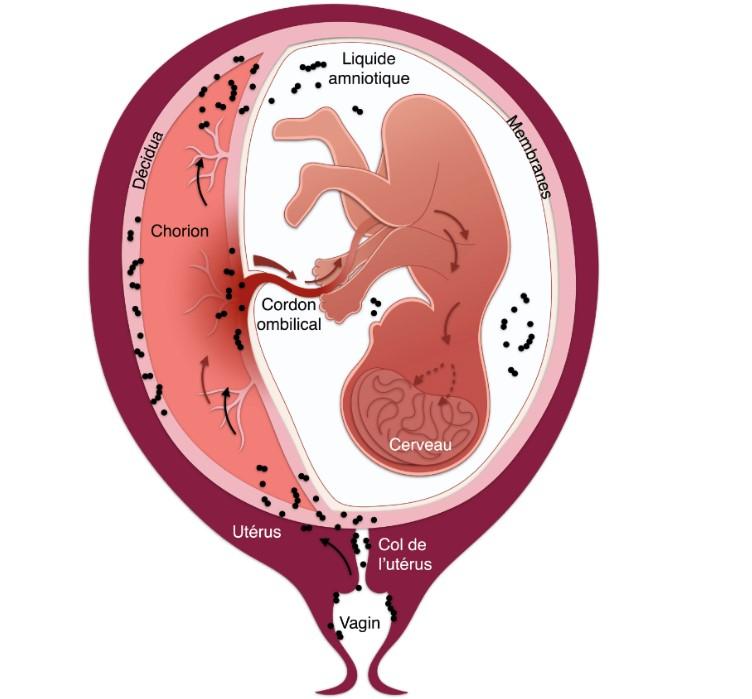 Nhiễm liên cầu khuẩn nhóm B ở phụ nữ mang thai