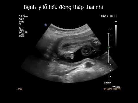 TỔNG QUAN VỀ BỆNH LỖ TIỂU ĐÓNG THẤP