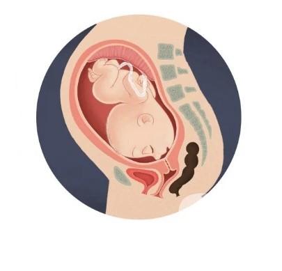 Cơ chế sinh và cách xử trí khi sinh thai nhi ngôi mặt