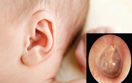 Những dấu hiệu cảnh báo trẻ bị viêm tai giữa