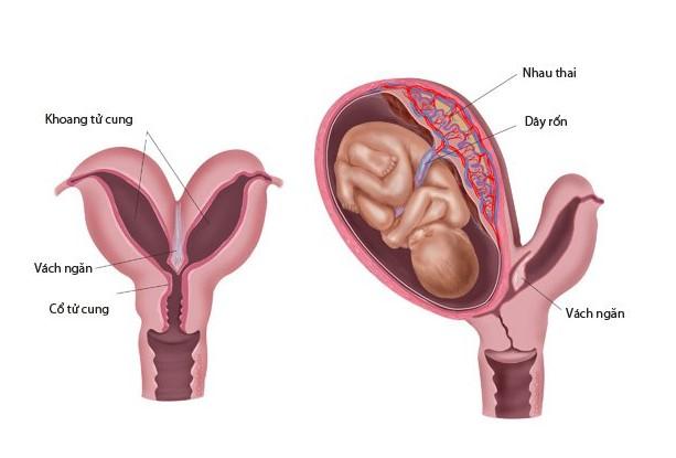 Tử cung hai sừng ảnh hưởng như thế nào đến việc mang thai