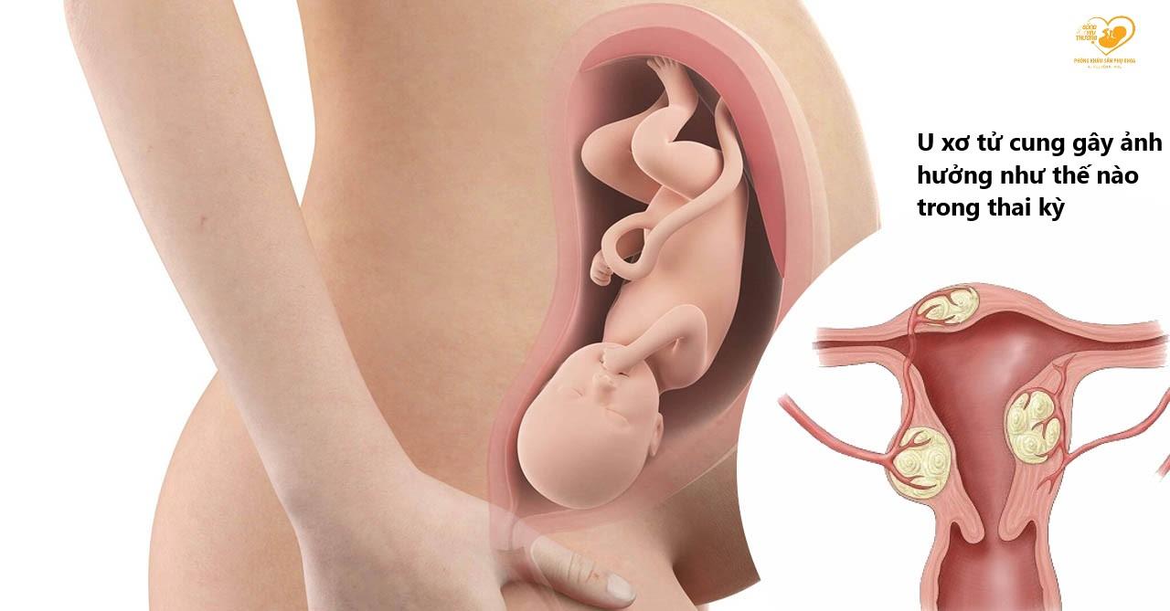 U xơ tử cung gây nguy hiểm như thế nào trong thai kỳ?