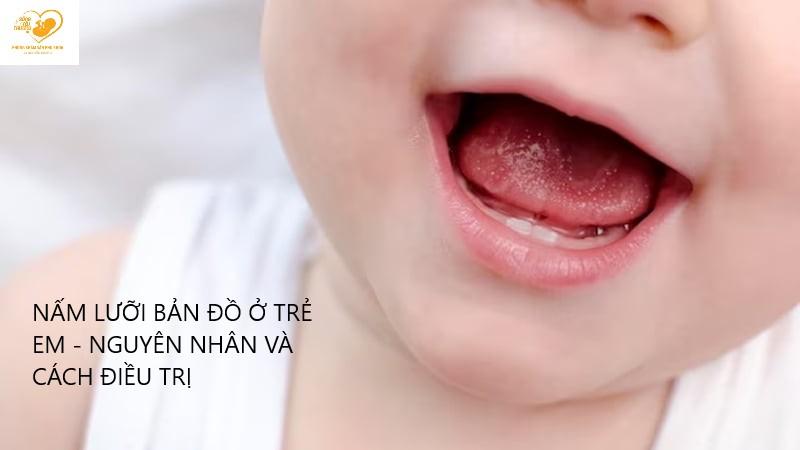 Viêm lưỡi bản đồ ở trẻ em, nguyên nhân, triệu chứng và cách điều trị