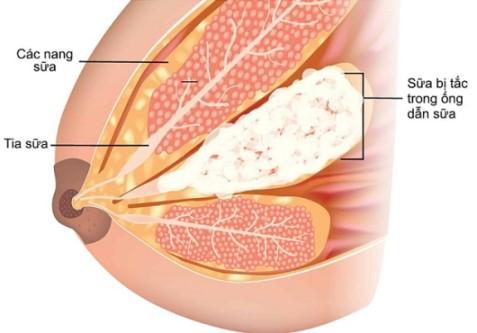 Một số vấn đề tuyến vú thời kì cho con bú