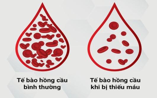 Thiếu máu trong thai kỳ và biến chứng có thể xảy ra