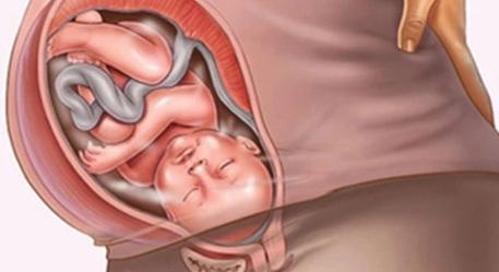 Dấu hiệu gợi ý thiểu ối: Khi nào mẹ bầu nên cảnh giác?