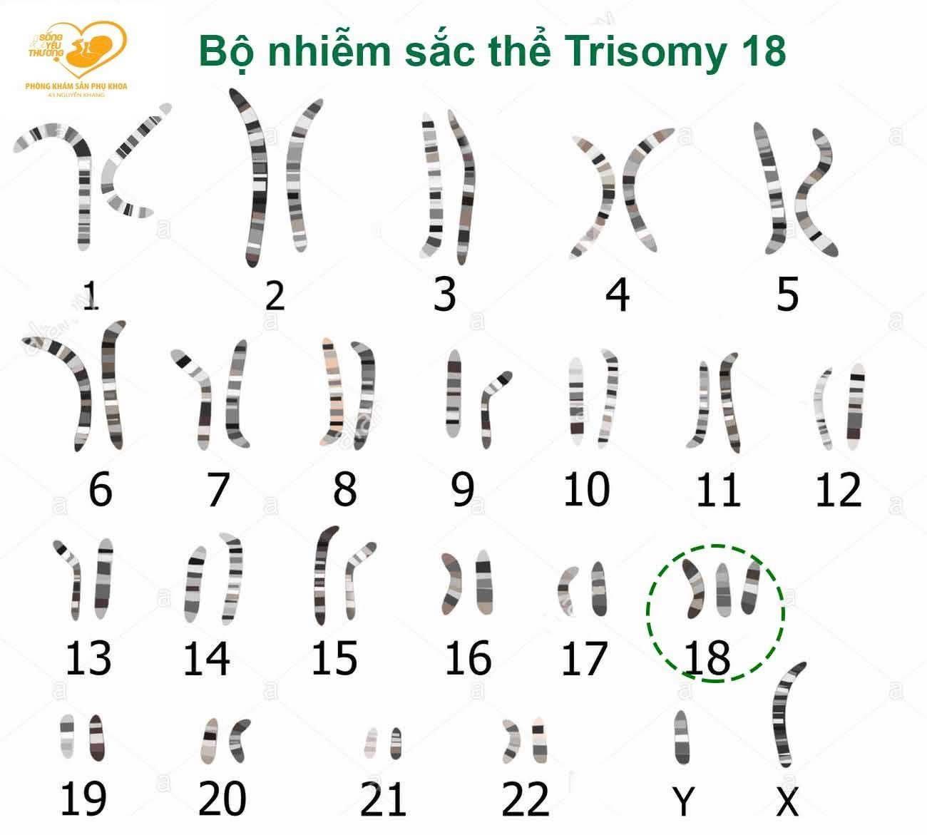 Hội chứng Edwards - Trisomy 18