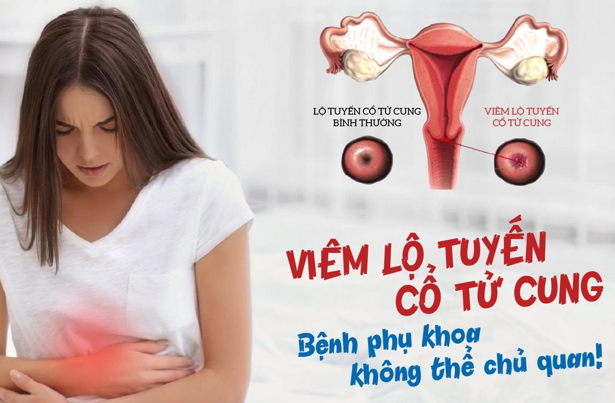 Viêm lộ tuyến: chữa sớm thì dễ, để trễ thì nguy