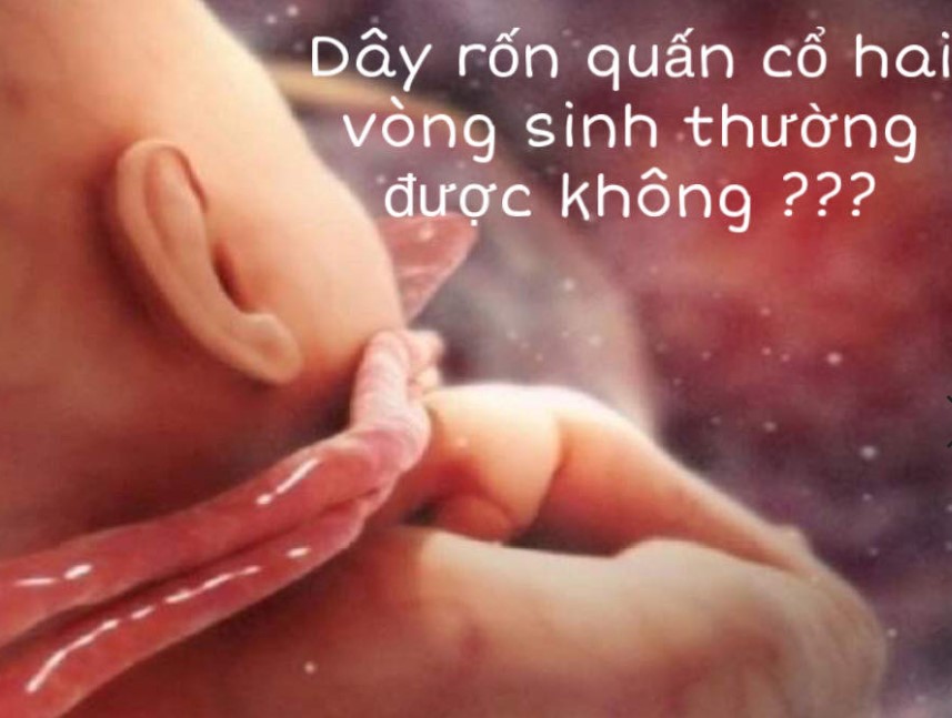 Dây rốn quấn cổ hai vòng có sinh thường được không?