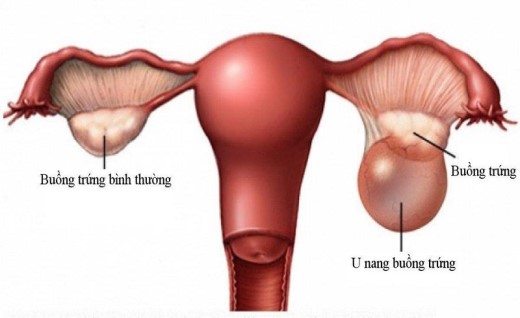 Tiến triển và biến chứng của u nang buồng trứng thực thể