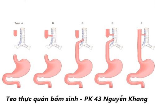 Dấu hiệu bệnh lý teo thực quản và lời khuyên cho mẹ bầu