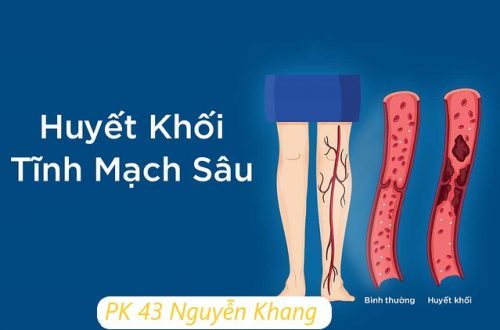 Bệnh huyết khối tĩnh mạch sâu gây nguy hiểm như thế nào?