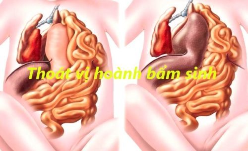 Thoát vị hoành bẩm sinh – bệnh lý nguy hiểm mẹ bầu cần biết