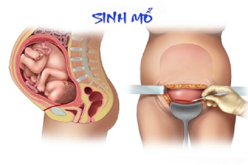 Giải đáp thắc mắc của mẹ bầu về vấn đề sinh mổ