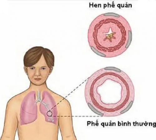 Cách phòng ngừa hen phế quản ở trẻ sơ sinh