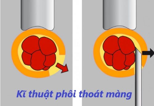 Kĩ thuật phôi thoát màng là gì