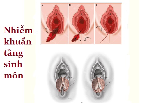 Nhiễm khuẩn tầng sinh môn – âm hộ – âm đạo – cổ tử cung