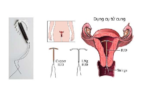 Những lưu ý khi đặt dụng cụ tử cung