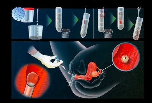 Quy trình thực hiện bơm tinh trùng và những điều bạn cần lưu ý