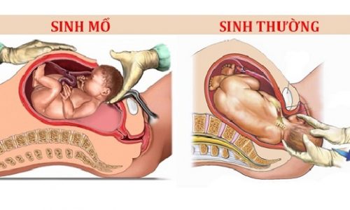 Sinh mổ và sinh thường phương pháp sinh nào tốt hơn?