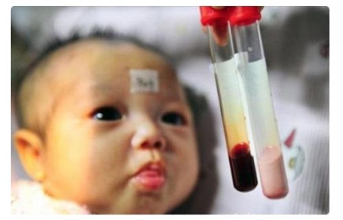 Biểu hiện của bệnh thalassemia ở trẻ em