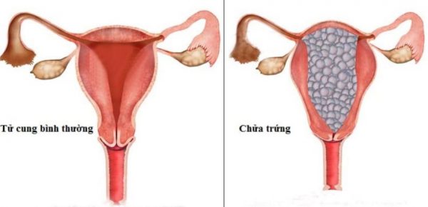 Nguyên nhân gây tăng beta hCG sau hút thai trứng là gì?
