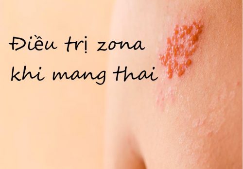 Cách phòng và điều trị bệnh zona khi mang thai