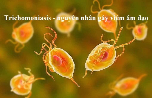 Trichomoniasis - nguyên nhân gây viêm âm đạo