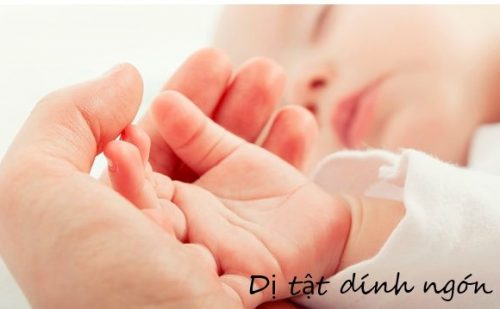 Tất tần tật về dị tật dính ngón