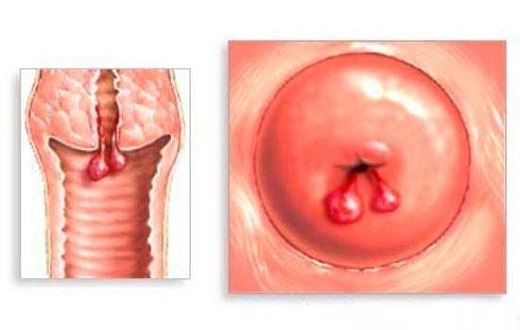 Polyp cổ tử cung là gì? triệu chứng và điều trị